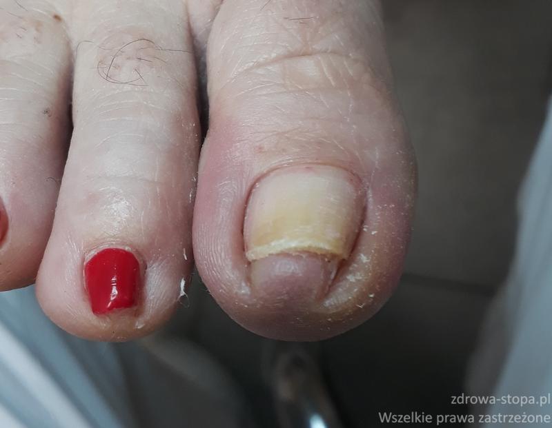 Bezpieczna rehabilitacja po grzybicy paznokci