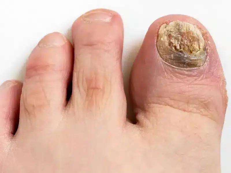 Diagnoza i leczenie grzybicy paznokci u sportowców